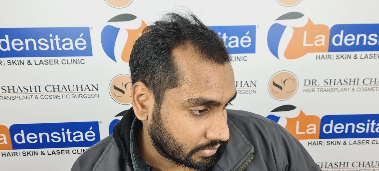 Shreyankar Maurya Before Hair Transplant
